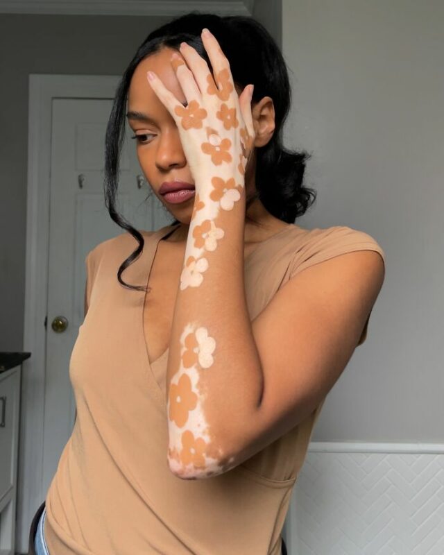 Amara Aleman’s “ArtSpots” Transforming Vitiligo Into Vibrant Art (20